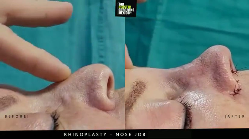 Nose Job - Rhinoplasty in Mexico - TopPlasticSurgeonsMexico 15